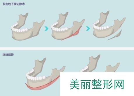 成都做下颌角截骨多少钱