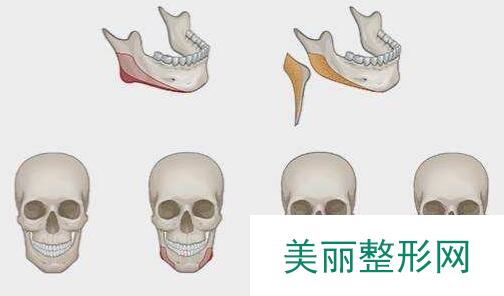 成都做下颌角截骨多少钱