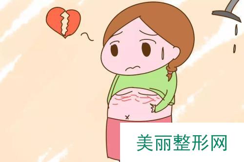 北京去妊娠纹选择激光需要多少钱