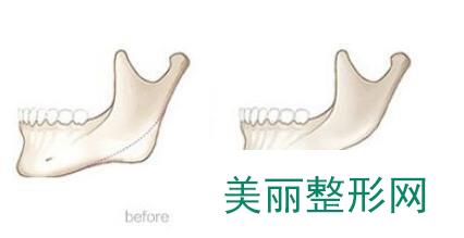 下颌角切除费用多少钱？下颌角切除手术价格是多少？