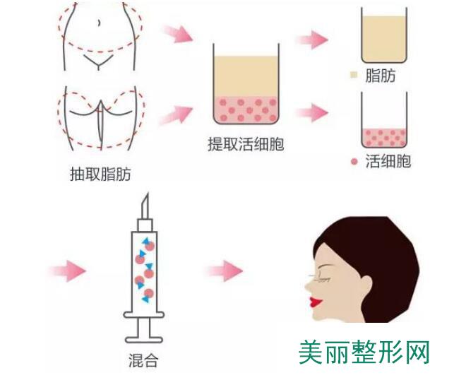 成都自体脂肪全脸填充贵吗?影响价格的因素有哪些?