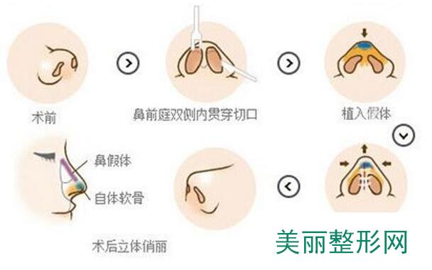 人工骨隆鼻价格