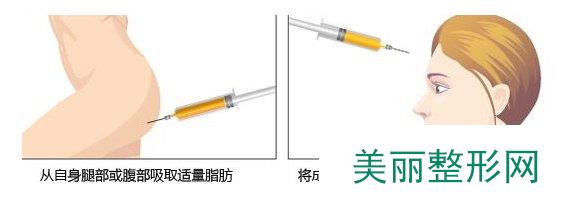 成都自体脂肪丰额头价格表 成都自体脂肪丰额头多少钱