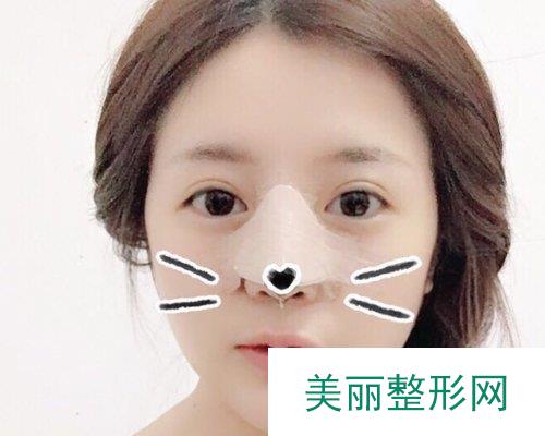 2019武汉美莱鼻部整形价格表及案例展示