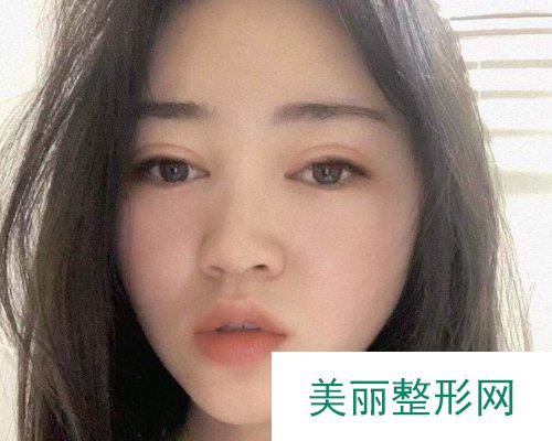 长沙美莱整形2019全新价格表详览及双眼皮恢复过程展示