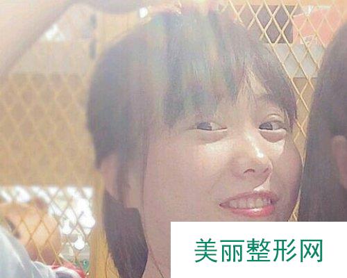 杭州华山连天美医院2019全新价格表一览及双眼皮案例分享