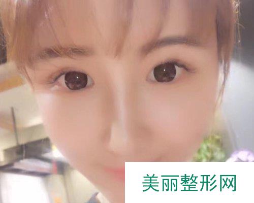 杭州格莱美整形医院2019价格表倾情分享及自体脂肪填充面部案例分享