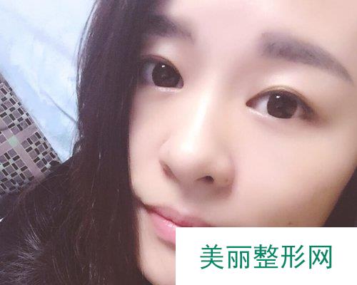 杭州美莱医院2019价格表详览及双眼皮果分享