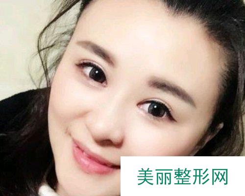 杭州美莱医院2019价格表详览及双眼皮果分享