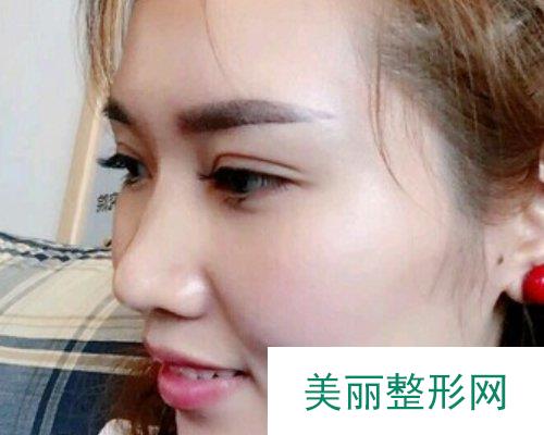 云南昆明华美美莱医院2019价格表详览及切开双眼皮恢复日记