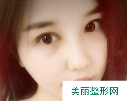 云南昆明华美美莱医院2019价格表详览及切开双眼皮恢复日记