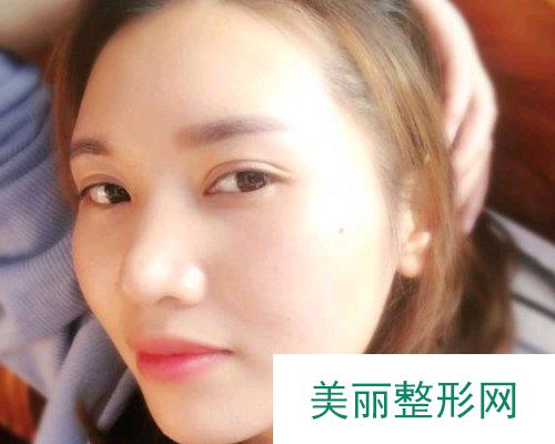 云南昆明华美美莱医院2019价格表详览及切开双眼皮恢复日记