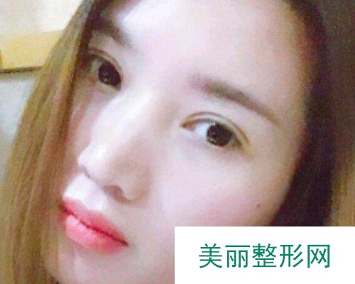 云南昆明华美美莱医院2019价格表详览及切开双眼皮恢复日记