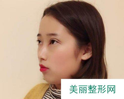 北京华韩医疗美容价格表，附双眼皮案例展示