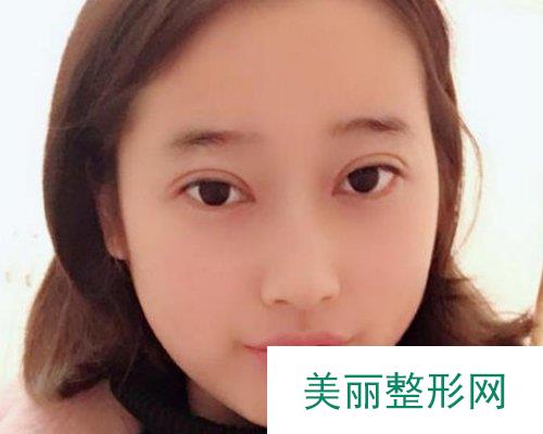 北京华韩医疗美容价格表，附双眼皮案例展示