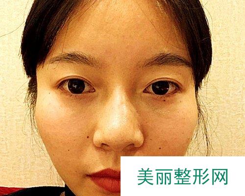 深圳美莱医院2019全新价格表一览及自体脂肪填充面部果分享