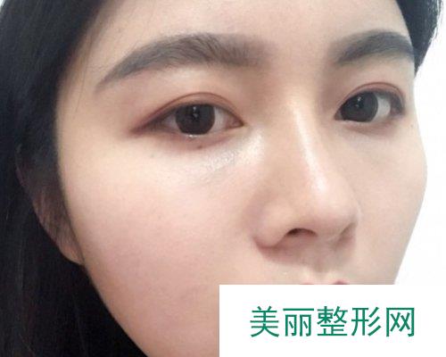 深圳美莱医院2019全新价格表一览及自体脂肪填充面部果分享