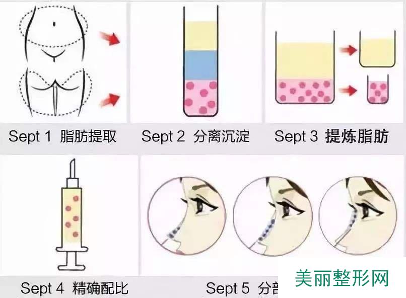 自体脂肪隆鼻