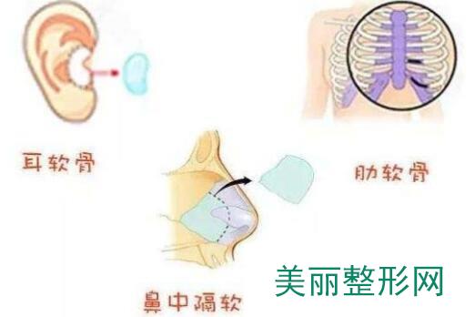 鼻中隔软骨隆鼻