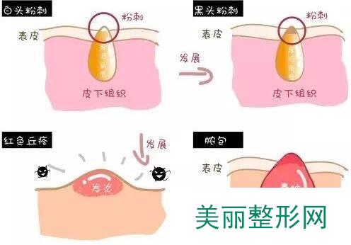 激光去粉刺