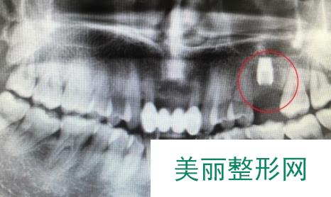 华西口腔种植牙案例