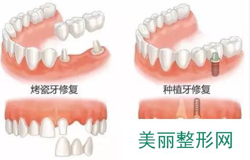 上海烤瓷牙价格表2019