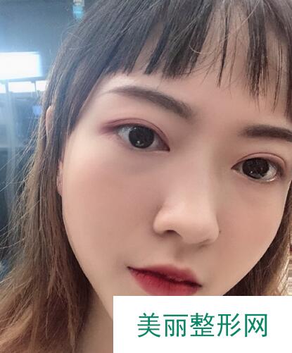 膨体隆鼻术后详情图分享来啦，仙女们不要错过哦~