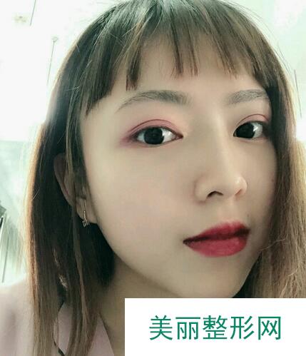 膨体隆鼻术后详情图分享来啦，仙女们不要错过哦~