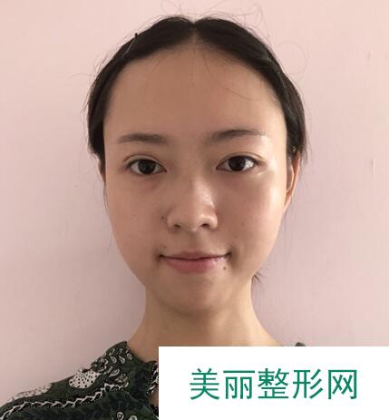 膨体隆鼻术后详情图分享来啦，仙女们不要错过哦~