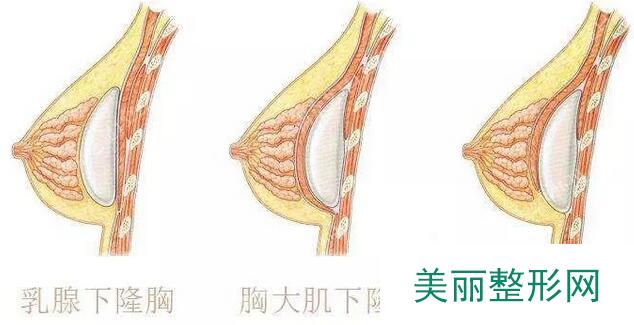 双平面隆胸术一周后的果照片分享给大家看看~