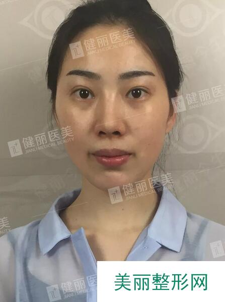 健丽填了脂肪的她气堂全开，  一张少女脸嫩得像18岁？