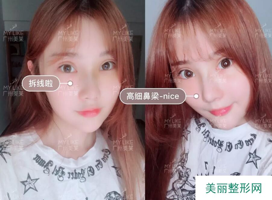 广州美莱刘豪隆鼻案例分享，果灰常理想~