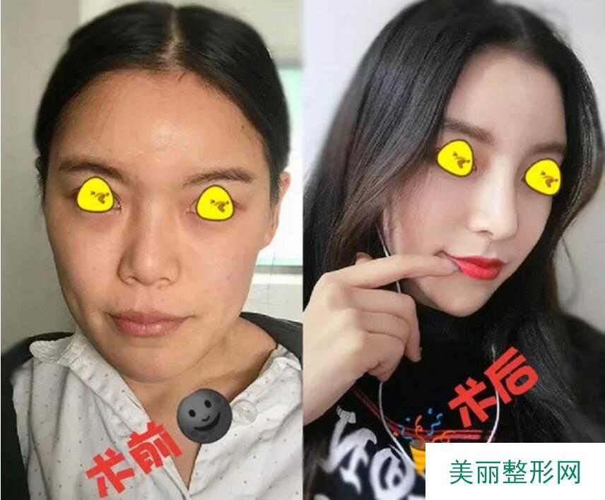 自体肋软骨隆鼻术后2个月，不再做出租屋里痛哭的女孩~