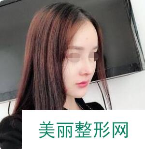 玻尿酸注射隆鼻手术后的第30天