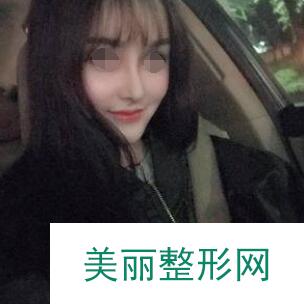 玻尿酸注射隆鼻手术后