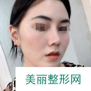 做了鼻部整形手术的第30天