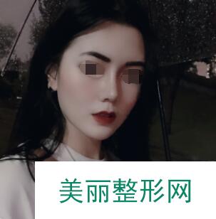 做了鼻部整形手术的第50天