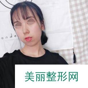 隆鼻术后注意事项