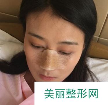 重庆好美隆鼻怎么样？毕胜肋软骨隆鼻前后对比很明X