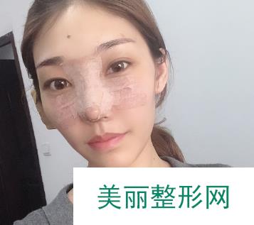 成都纽莱茵医疗美容郑在祐隆鼻案例，来了解下他的技术吧！