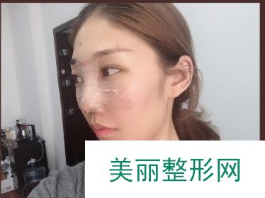 成都纽莱茵医疗美容郑在祐隆鼻案例，来了解下他的技术吧！