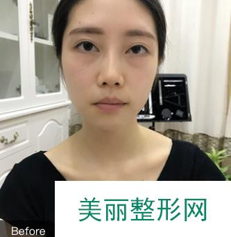 洛阳四院整形科做假体垫下巴术后20天恢复果照，直接改变了我的脸型