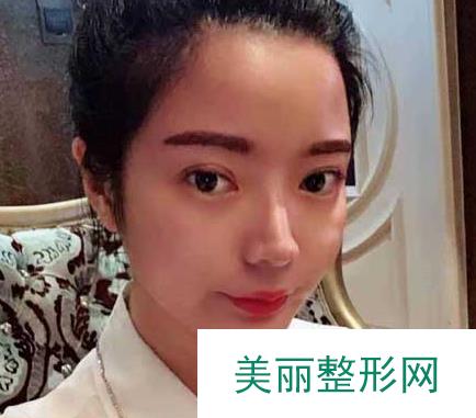 长沙美之峰医疗美容刘磊怎么样？割双眼皮2个月的恢复果照