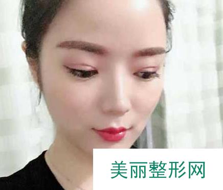 长沙美之峰医疗美容刘磊怎么样？割双眼皮2个月的恢复果照