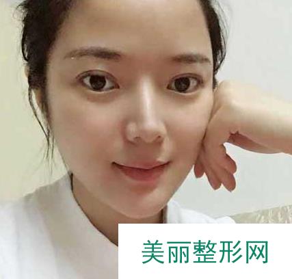 长沙美之峰医疗美容刘磊怎么样？割双眼皮2个月的恢复果照