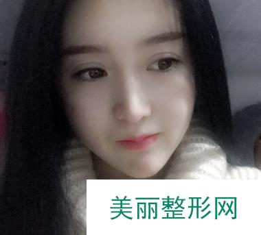 郑州美莱双眼皮术后三个月：你看看果还会觉得花6800元起贵吗？