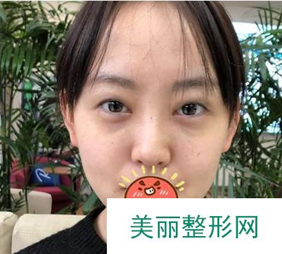 杭州整形医院整形美容科双眼皮怎么样？请看真人前后对比案例