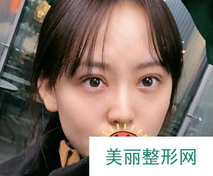 杭州整形医院整形美容科双眼皮怎么样？请看真人前后对比案例