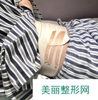 去武汉同济医院找【唐泓波】做腰腹部吸脂和大腿吸脂术后半年果图片