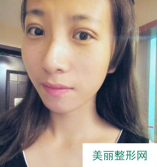 做了双眼皮 现在好激动啊 - 美尔贝刘医生 - 刘医生的整容日记